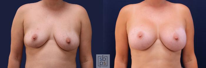 Before & After Breast Augmentation Case 488 Front View in Torrance, CA