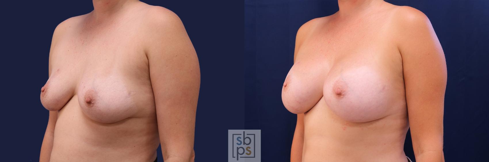 Before & After Breast Augmentation Case 488 Left Oblique View in Los Angeles & Torrance, CA, CA