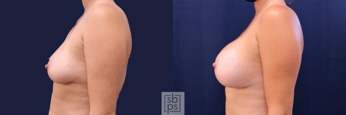 Before & After Breast Augmentation Case 488 Left Side View in Torrance, CA
