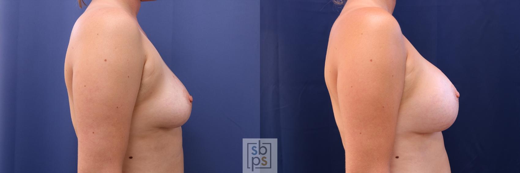 Before & After Breast Augmentation Case 488 Right Side View in Torrance & Los Angeles, CA, CA