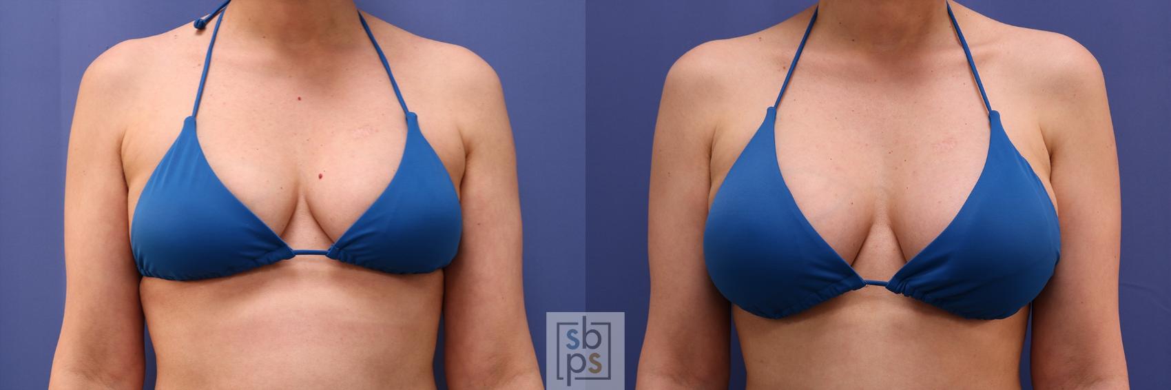 Before & After Breast Augmentation Case 495 Bikini Front View in Torrance & Los Angeles, CA, CA