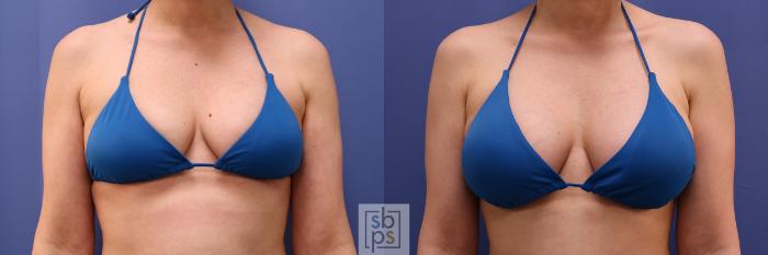 Before & After Breast Augmentation Case 495 Bikini Front View in Torrance, CA