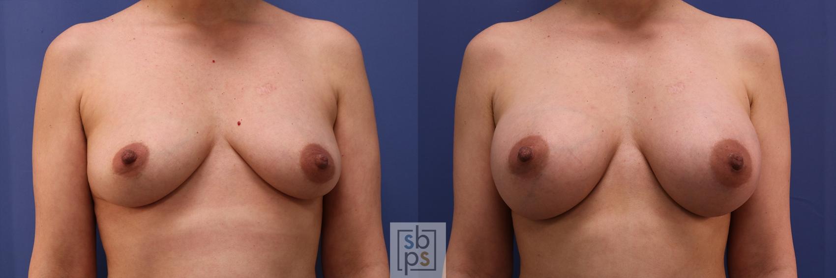 Before & After Breast Augmentation Case 495 Front View in Torrance, CA