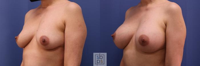 Before & After Breast Augmentation Case 495 Left Oblique View in Torrance, CA