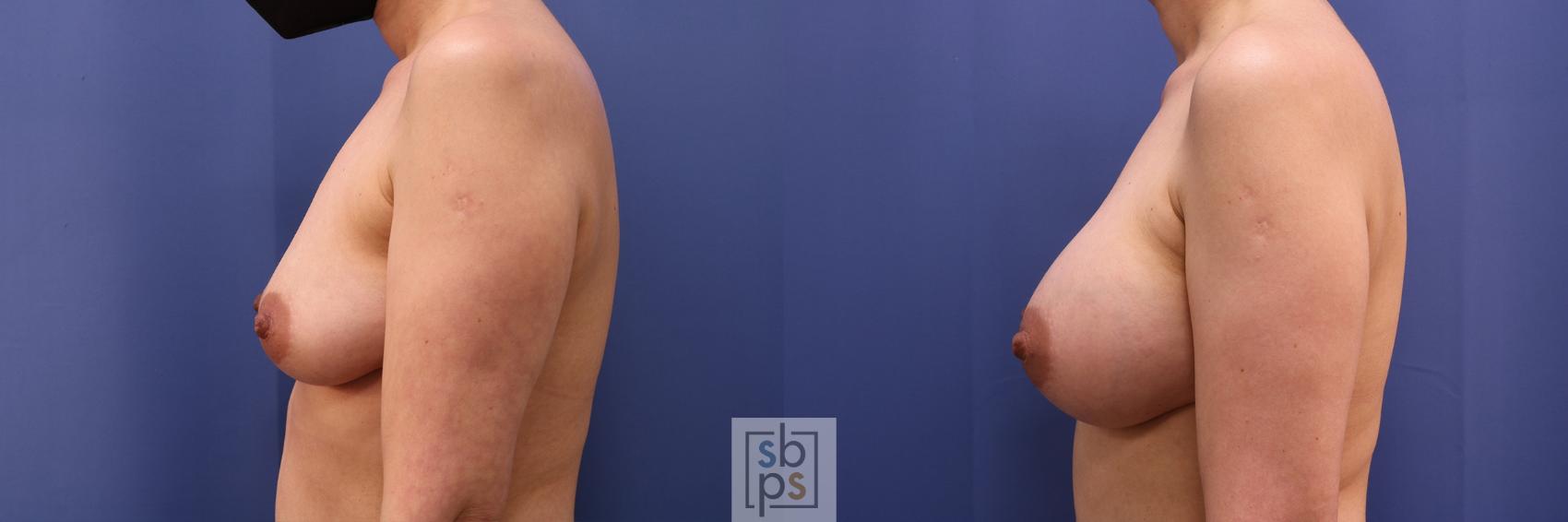 Before & After Breast Augmentation Case 495 Left Side View in Torrance & Los Angeles, CA, CA