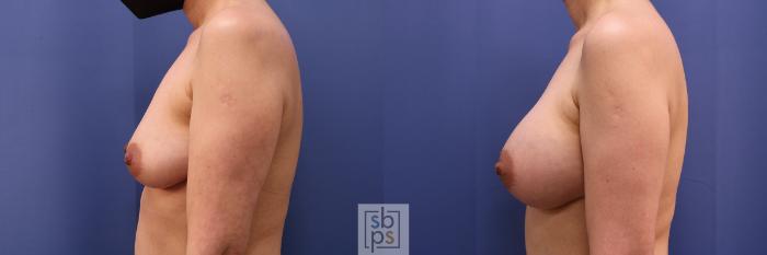 Before & After Breast Augmentation Case 495 Left Side View in Torrance, CA