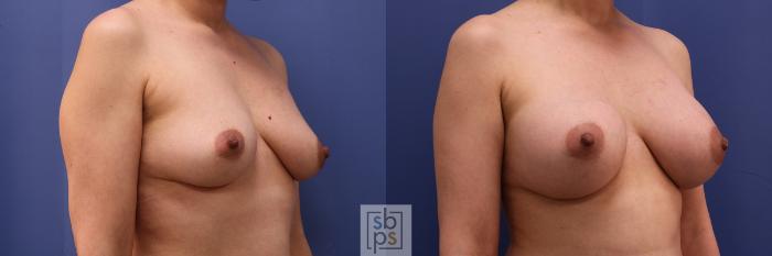 Before & After Breast Augmentation Case 495 Right Oblique View in Torrance, CA