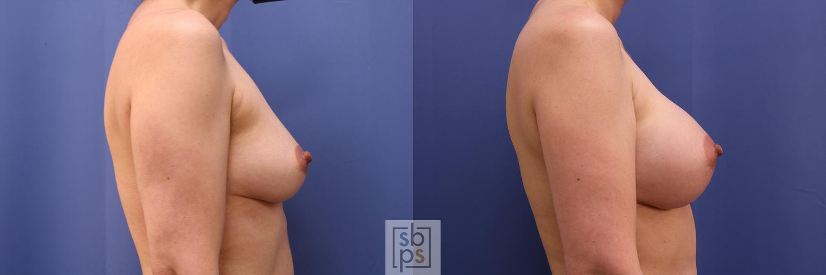 Before & After Breast Augmentation Case 495 Right Side View in Torrance & Los Angeles, CA, CA