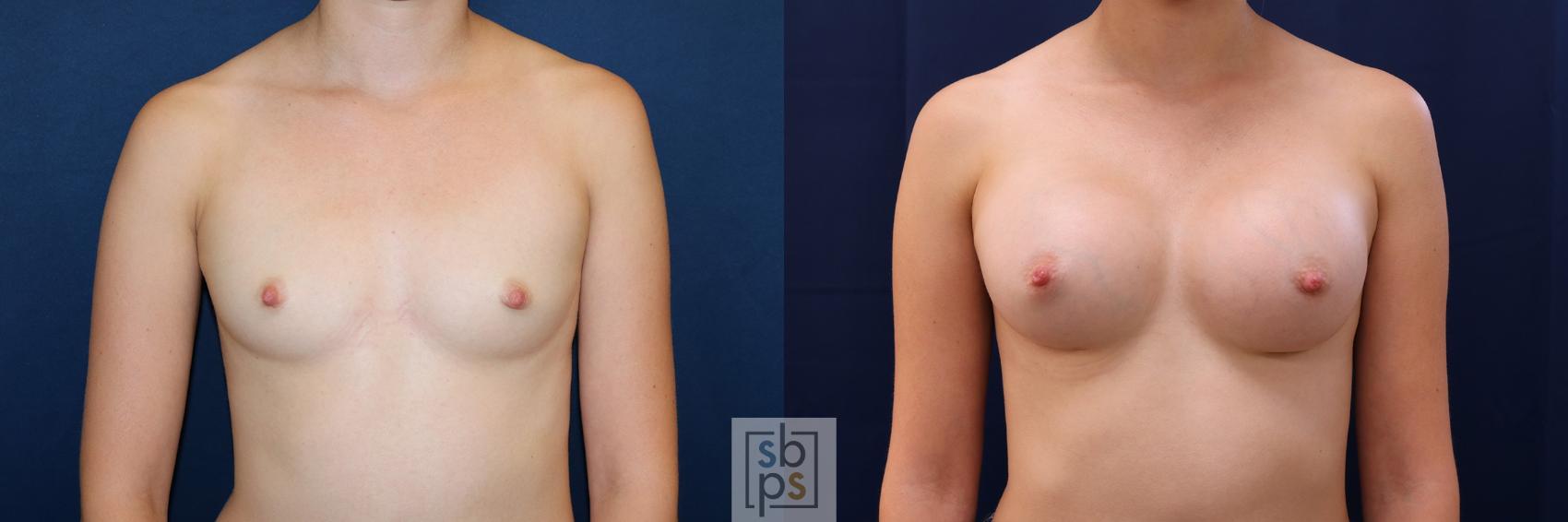 Before & After Breast Augmentation Case 500 Front View in Torrance, CA