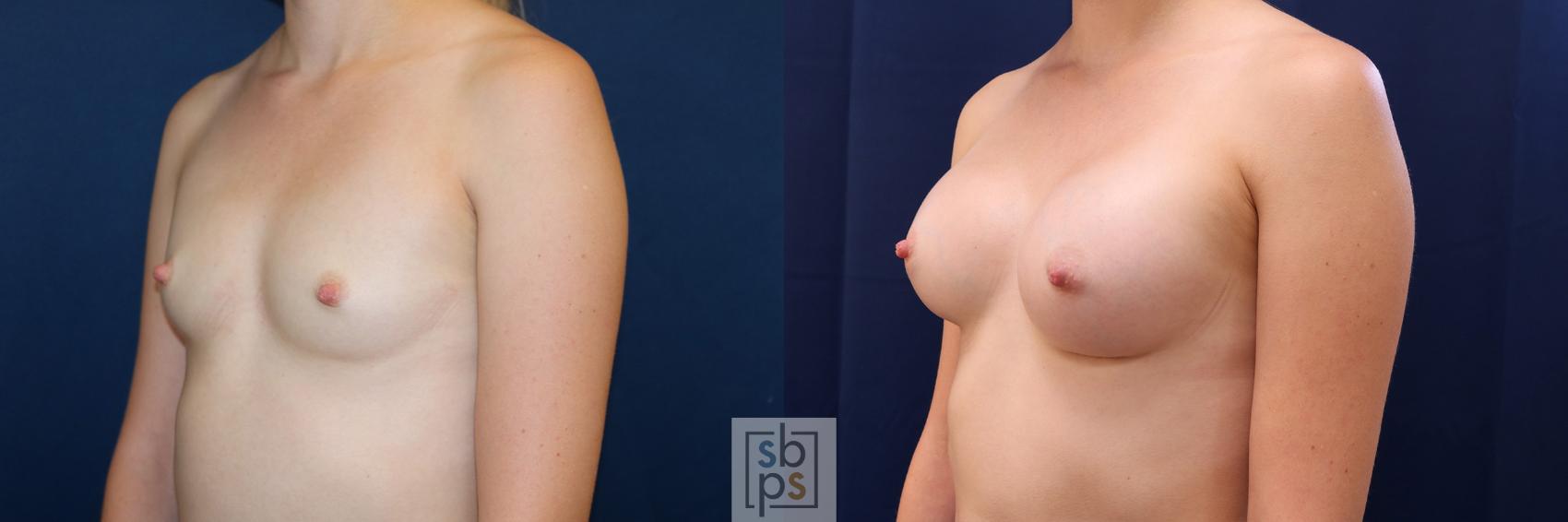 Before & After Breast Augmentation Case 500 Left Oblique View in Torrance & Los Angeles, CA, CA