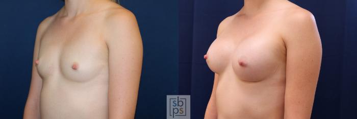 Before & After Breast Augmentation Case 500 Left Oblique View in Torrance, CA