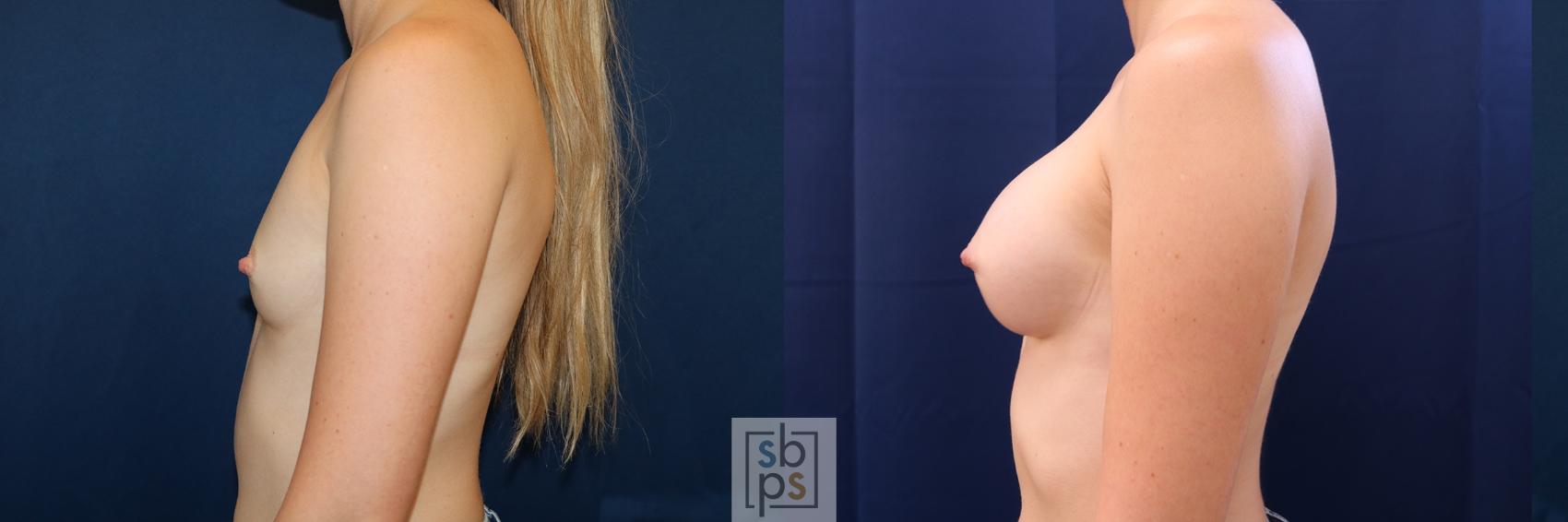 Before & After Breast Augmentation Case 500 Left Side View in Torrance & Los Angeles, CA, CA