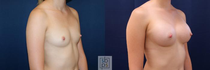 Before & After Breast Augmentation Case 500 Right Oblique View in Torrance, CA