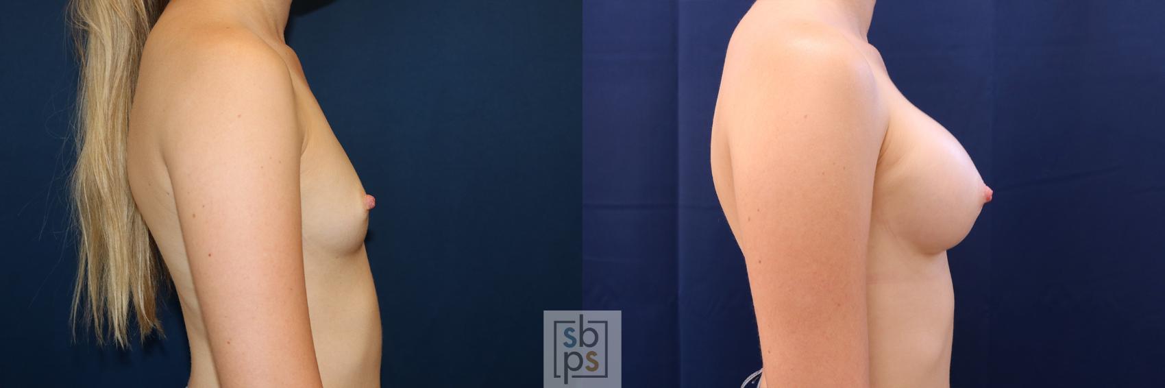 Before & After Breast Augmentation Case 500 Right Side View in Torrance & Los Angeles, CA, CA