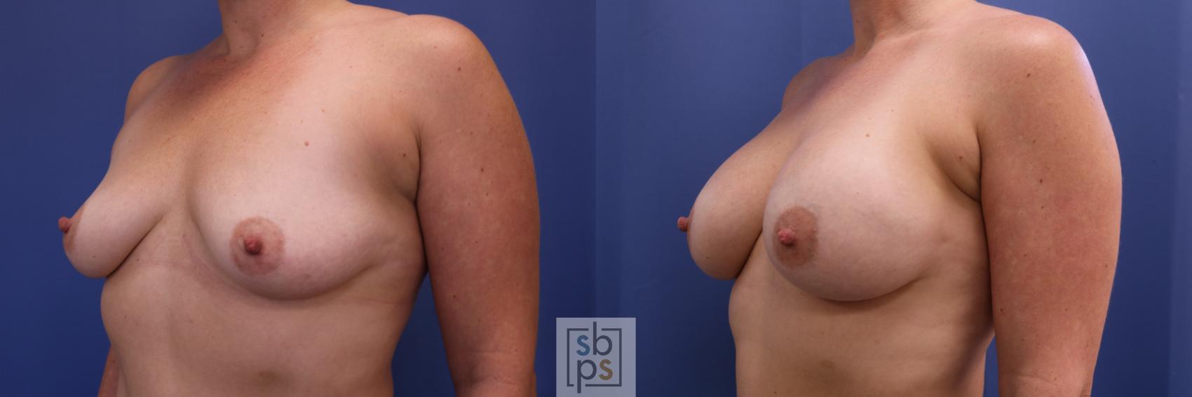 Before & After Breast Augmentation Case 503 Left Oblique View in Torrance & Los Angeles, CA, CA