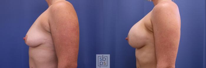 Before & After Breast Augmentation Case 503 Left Side View in Torrance, CA