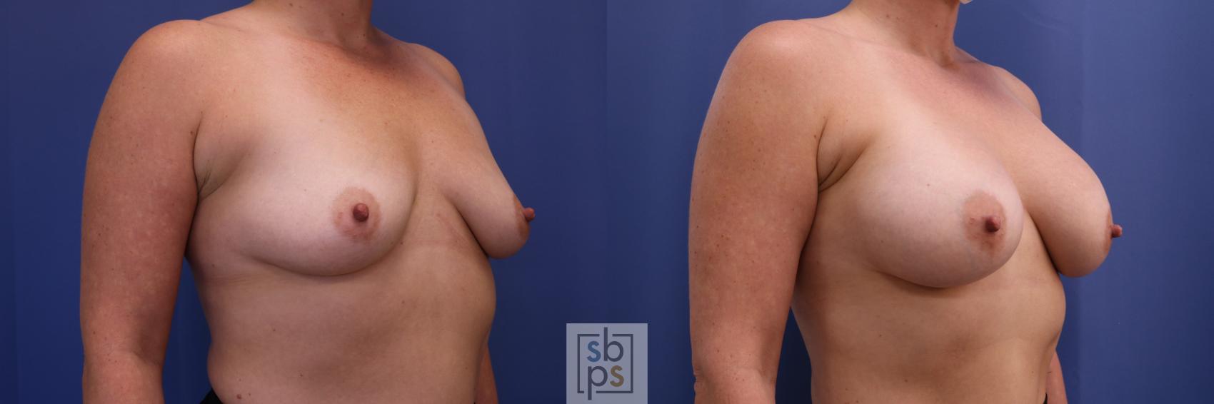 Before & After Breast Augmentation Case 503 Right Oblique View in Torrance & Los Angeles, CA, CA