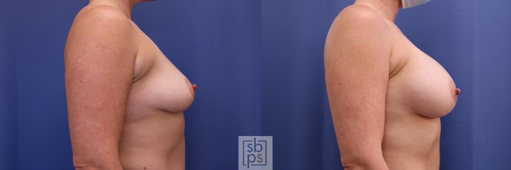 Before & After Breast Augmentation Case 503 Right Side View in Torrance & Los Angeles, CA, CA