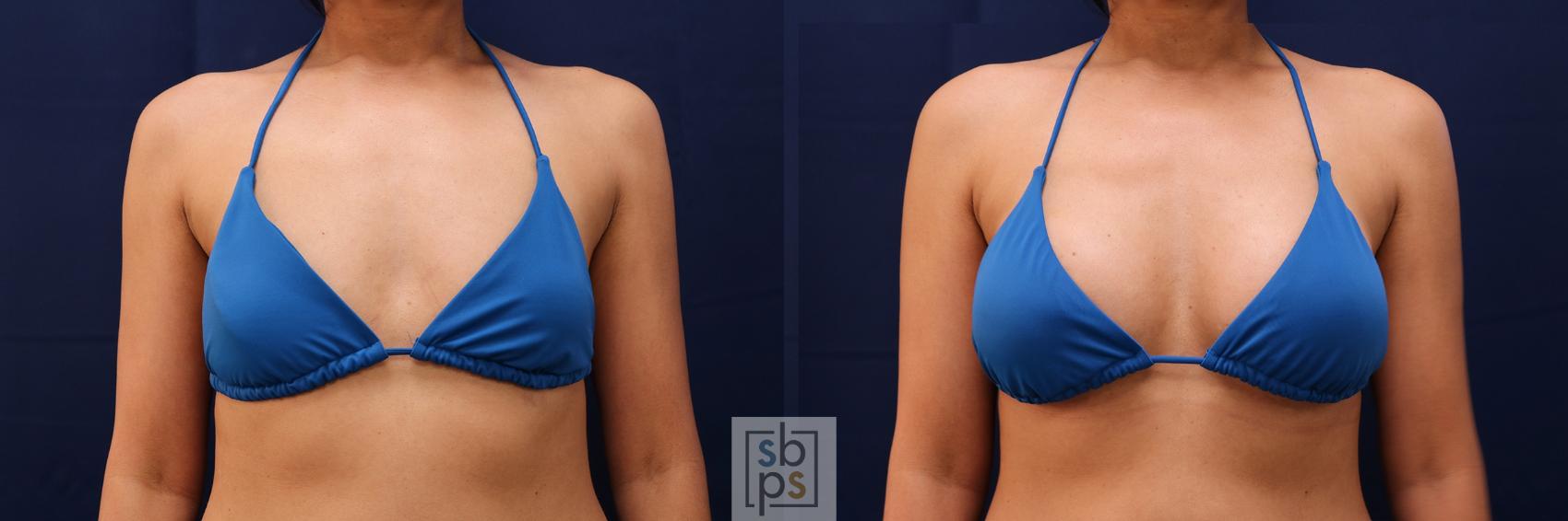 Before & After Breast Augmentation Case 515 Bikini Front View in Torrance & Los Angeles, CA, CA