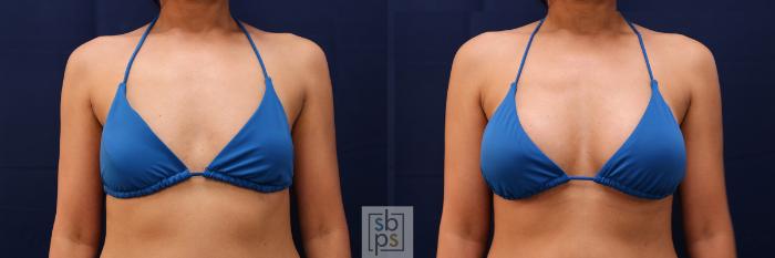 Before & After Breast Augmentation Case 515 Bikini Front View in Torrance, CA