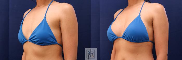Before & After Breast Augmentation Case 515 Bikini Left Oblique View in Torrance, CA