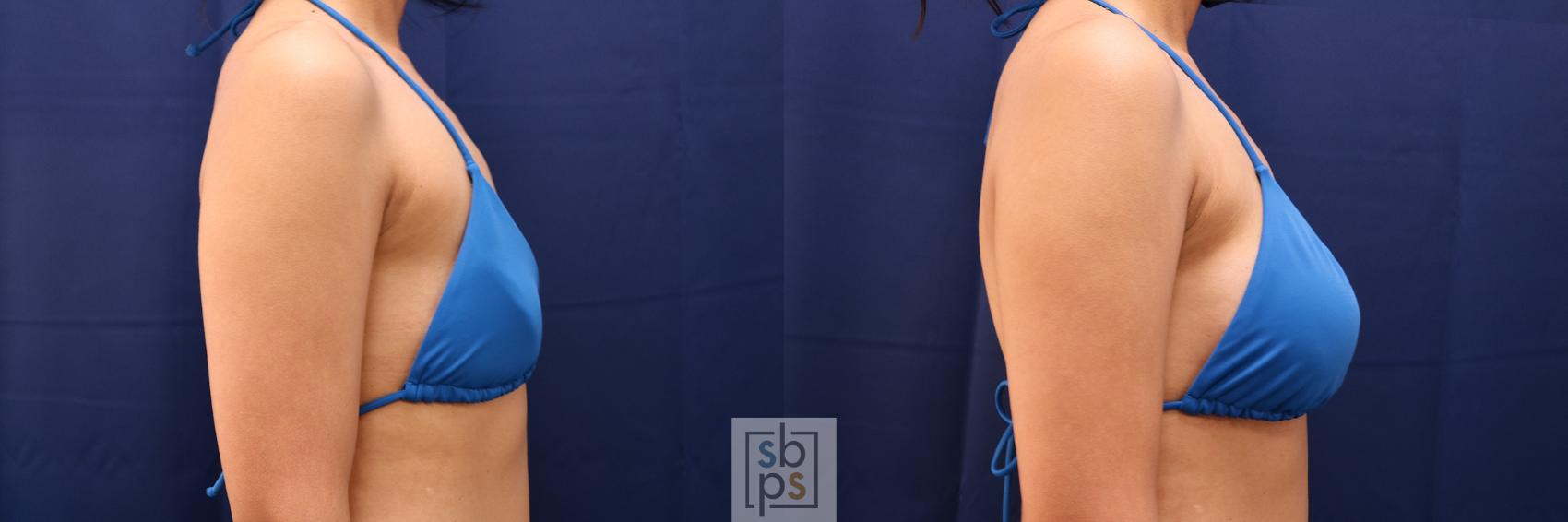 Before & After Breast Augmentation Case 515 Bikini Right View in Torrance & Los Angeles, CA, CA