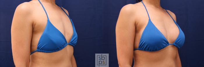 Before & After Breast Augmentation Case 515 Bikini Right Oblique View in Torrance, CA