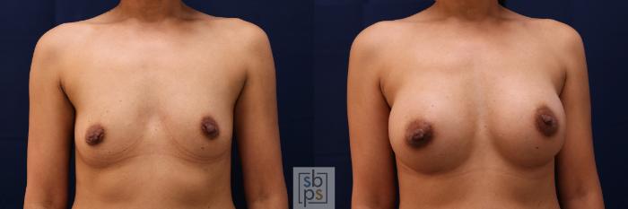 Before & After Breast Augmentation Case 515 Front View in Torrance, CA