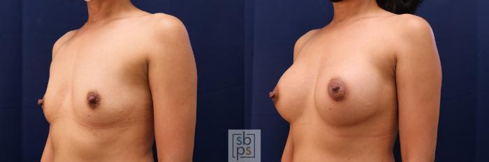 Before & After Breast Augmentation Case 515 Left Oblique View in Torrance, CA
