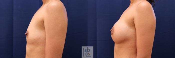 Before & After Breast Augmentation Case 515 Left Side View in Torrance, CA