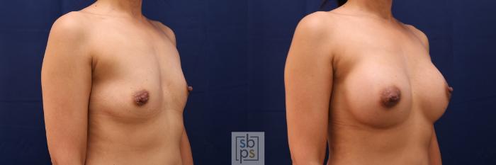 Before & After Breast Augmentation Case 515 Right Oblique View in Torrance, CA