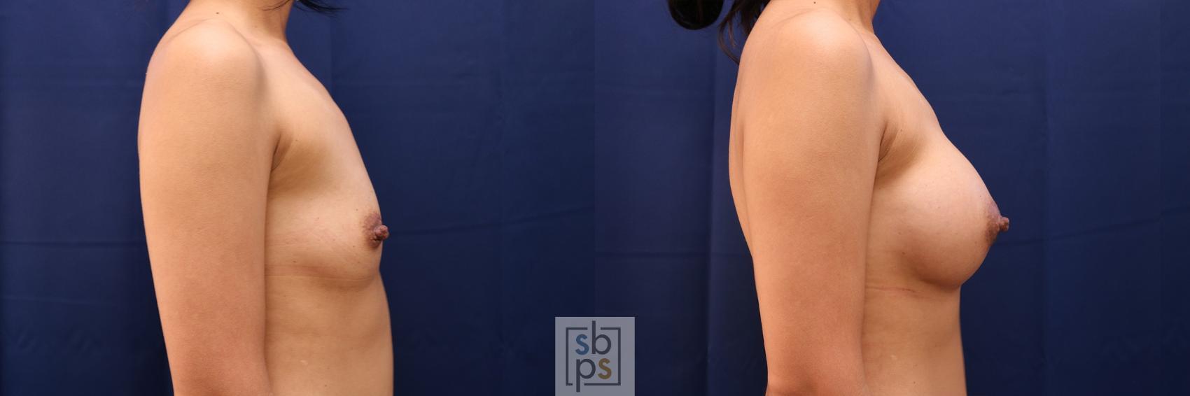 Before & After Breast Augmentation Case 515 Right Side View in Torrance & Los Angeles, CA, CA