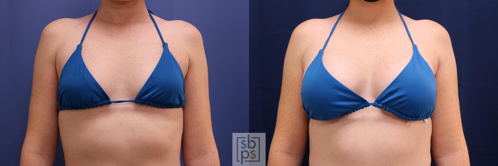 Before & After Breast Augmentation Case 528 Bikini Front View in Los Angeles, Torrance & Long Beach, CA