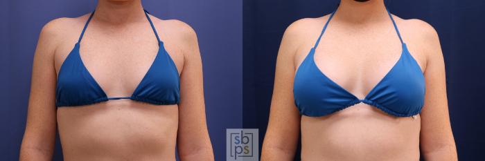 Before & After Breast Augmentation Case 528 Bikini Front View in Torrance, CA