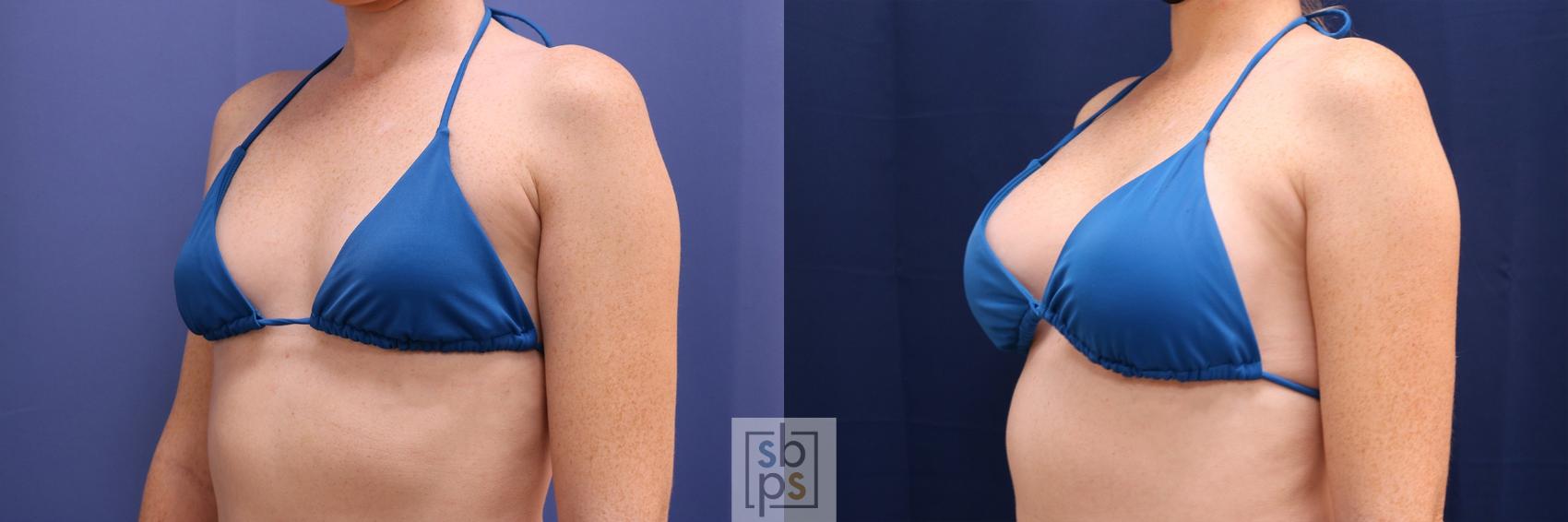Before & After Breast Augmentation Case 528 Bikini Left Oblique View in Los Angeles, Torrance & Long Beach, CA