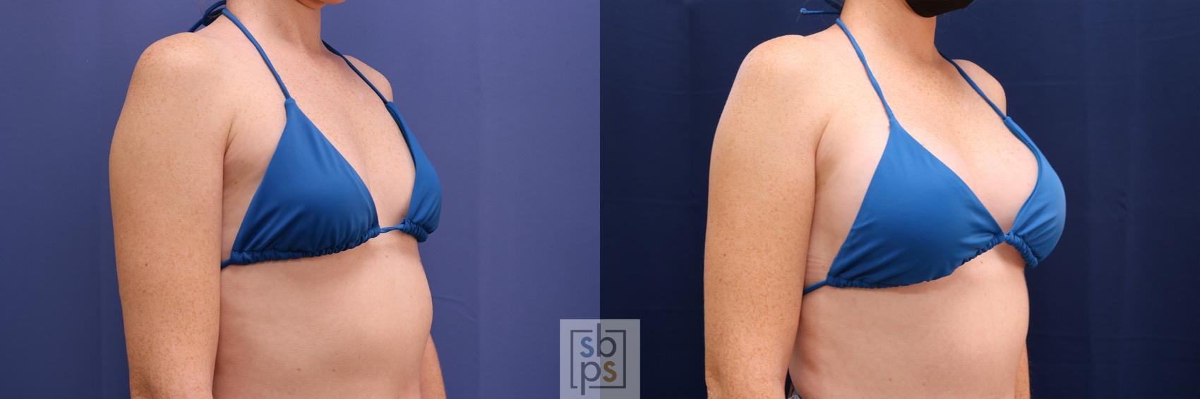 Before & After Breast Augmentation Case 528 Bikini Right Oblique View in Los Angeles, Torrance & Long Beach, CA