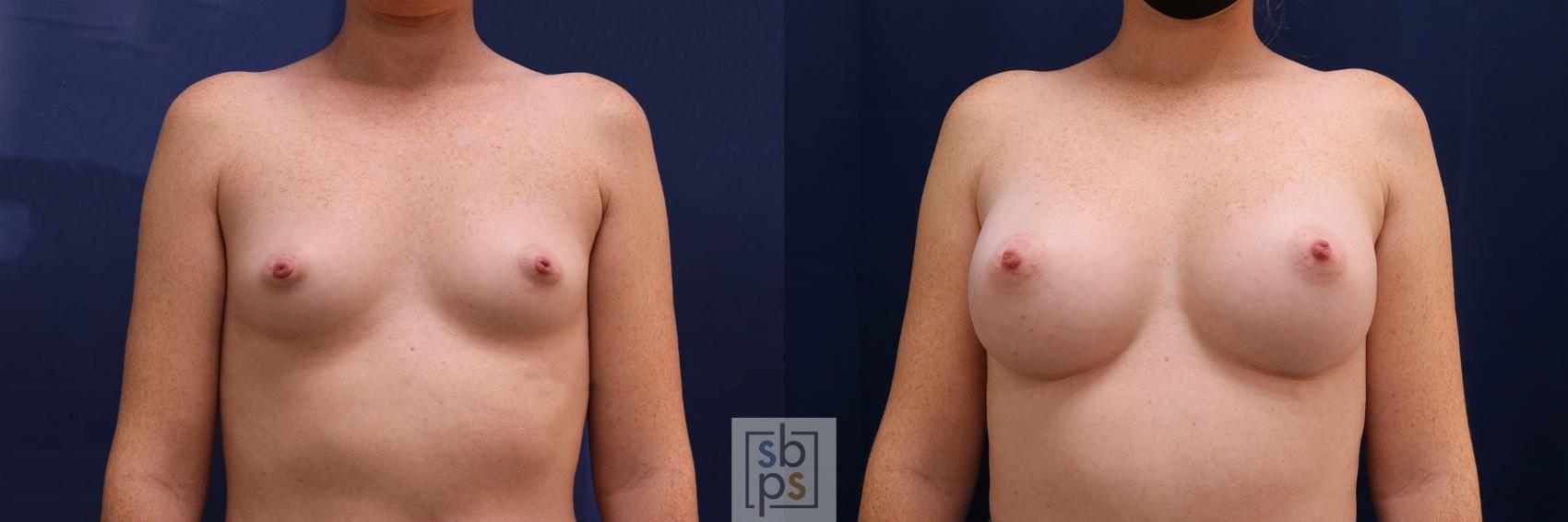 Before & After Breast Augmentation Case 528 Front View in Torrance, CA