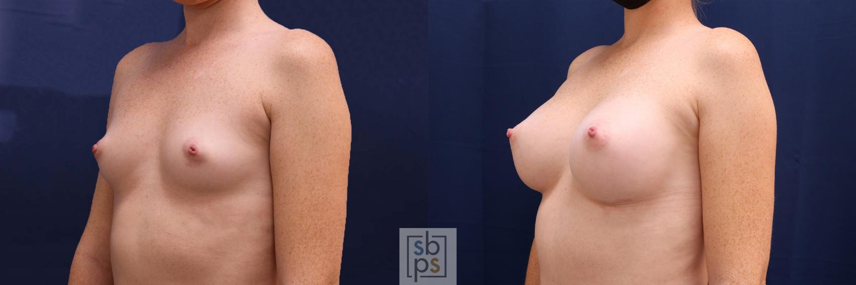Before & After Breast Augmentation Case 528 Left Oblique View in Los Angeles, Torrance & Long Beach, CA