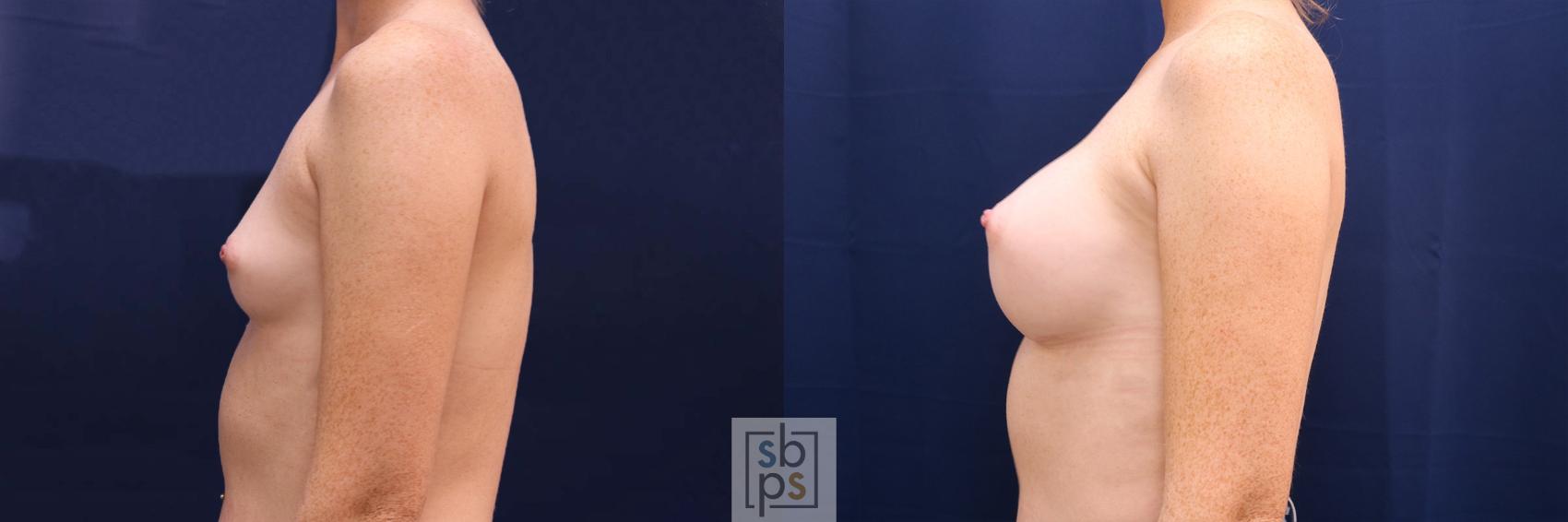 Before & After Breast Augmentation Case 528 Left Side View in Los Angeles, Torrance & Long Beach, CA
