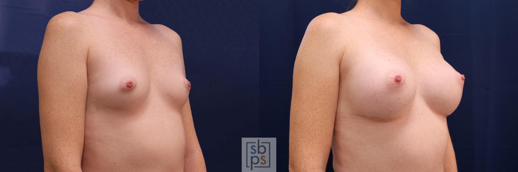 Before & After Breast Augmentation Case 528 Right Oblique View in Los Angeles, Torrance & Long Beach, CA