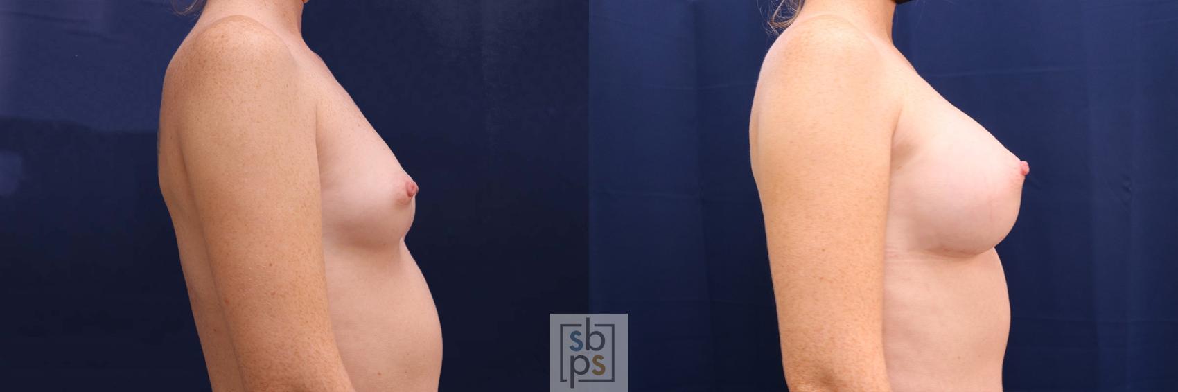 Before & After Breast Augmentation Case 528 Right Side View in Los Angeles, Torrance & Long Beach, CA