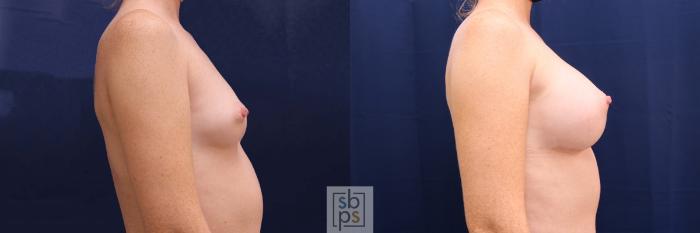 Before & After Breast Augmentation Case 528 Right Side View in Torrance, CA