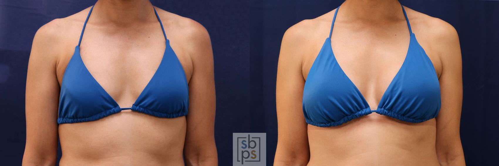 Before & After Breast Augmentation Case 530 Bikini Front View in Los Angeles, Torrance & Long Beach, CA