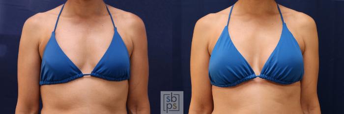 Before & After Breast Augmentation Case 530 Bikini Front View in Torrance, CA
