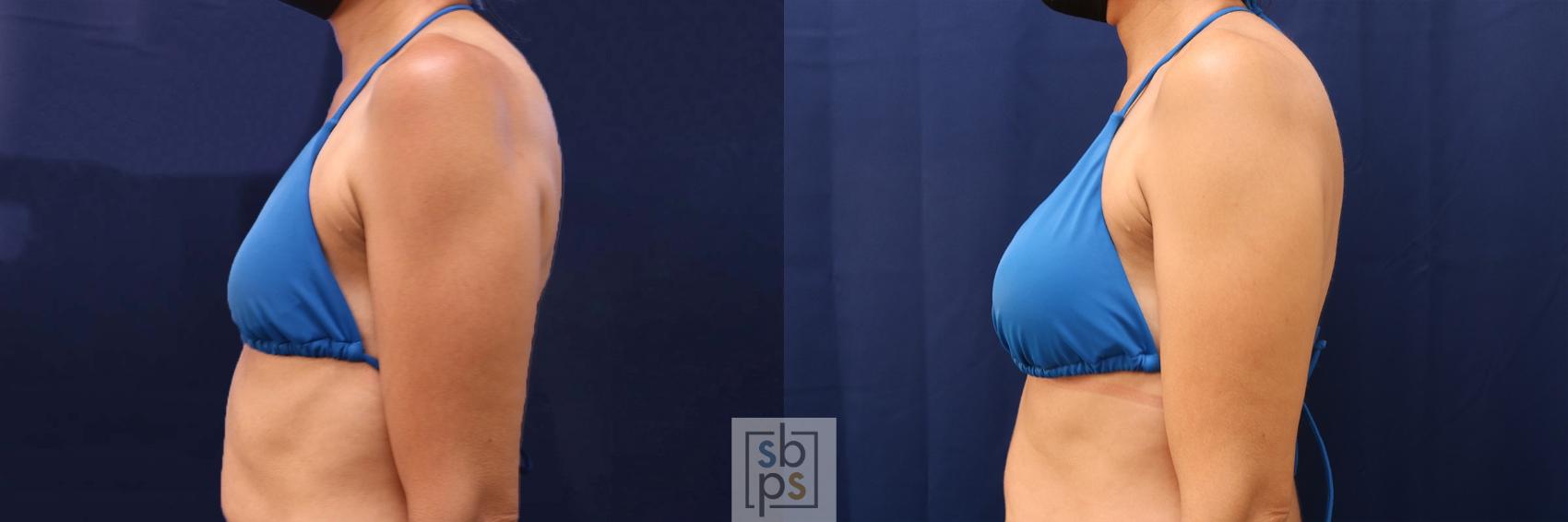 Before & After Breast Augmentation Case 530 Bikini Left View in Los Angeles, Torrance & Long Beach, CA