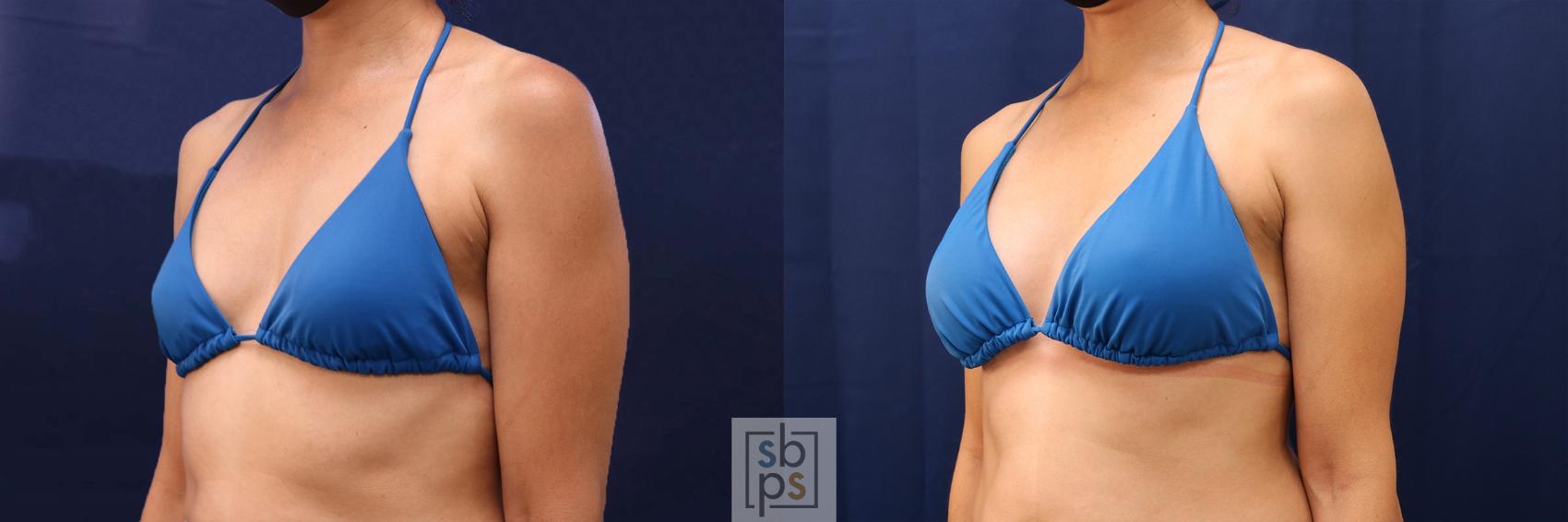 Before & After Breast Augmentation Case 530 Bikini Left Oblique View in Los Angeles, Torrance & Long Beach, CA