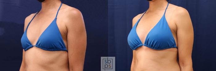 Before & After Breast Augmentation Case 530 Bikini Left Oblique View in Torrance, CA