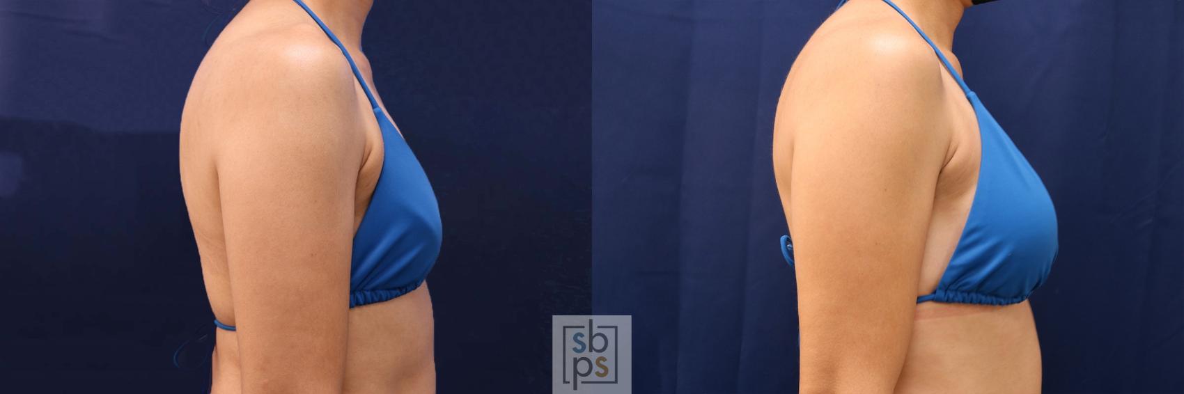 Before & After Breast Augmentation Case 530 Bikini Right View in Los Angeles, Torrance & Long Beach, CA