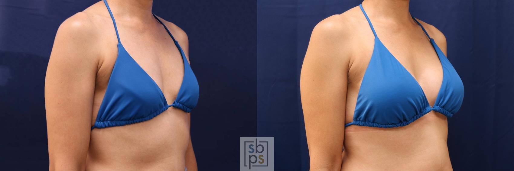 Before & After Breast Augmentation Case 530 Bikini Right Oblique View in Los Angeles, Torrance & Long Beach, CA