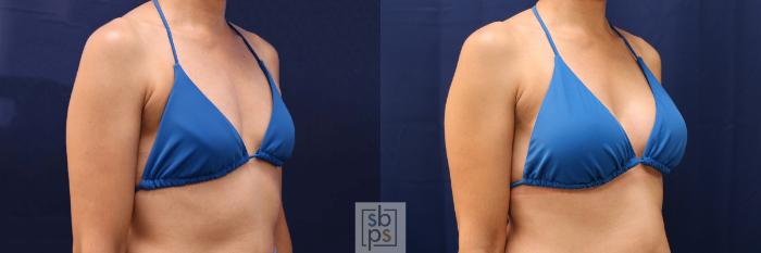 Before & After Breast Augmentation Case 530 Bikini Right Oblique View in Torrance, CA